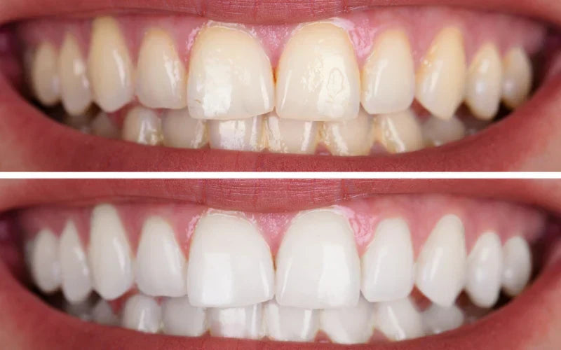 before and after teeth whitening pen