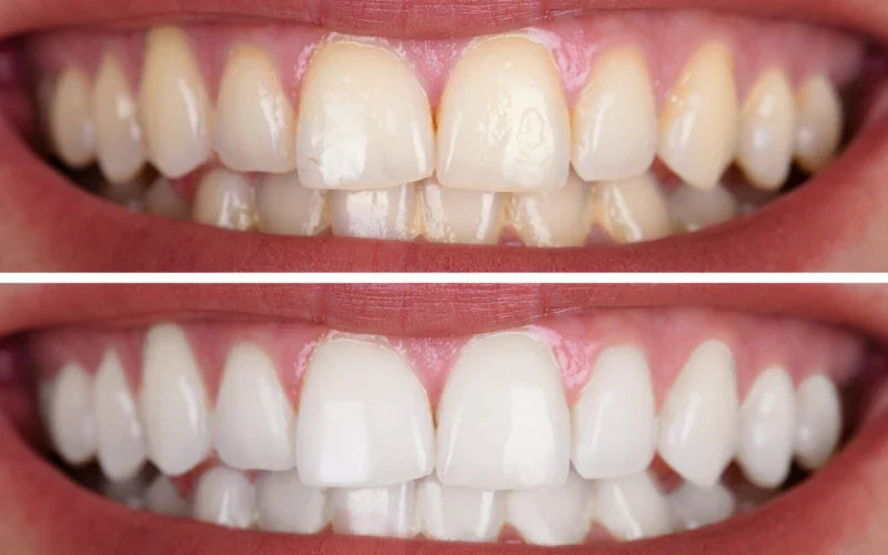 before and after teeth whitening pen