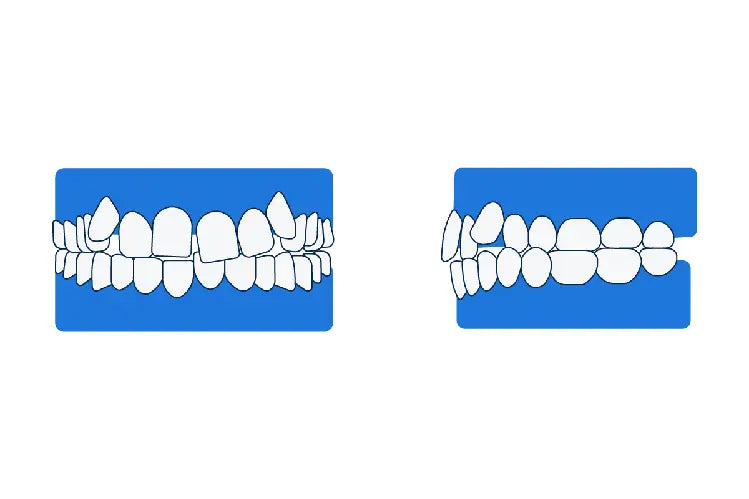 An illustration of crooked teeth