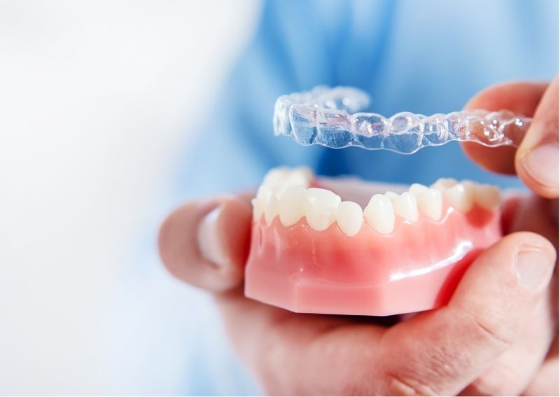 What are Lingual Braces and How They Work?