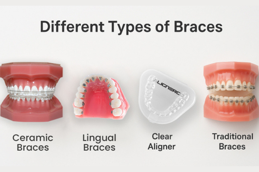 Types of clear braces