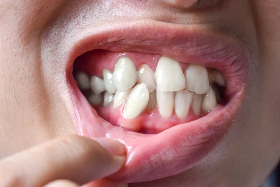 A close-up of crooked teeth