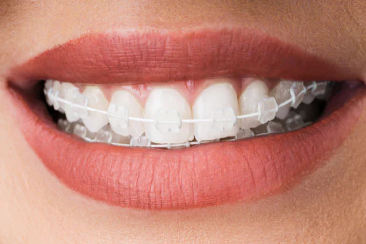 ceramic braces