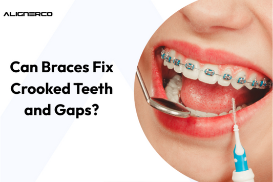 Can Braces Fix Crooked Teeth and Gaps?