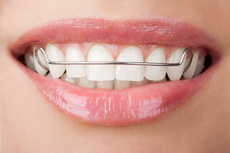 How Much are Retainers: Costs, Types, and What to Expect