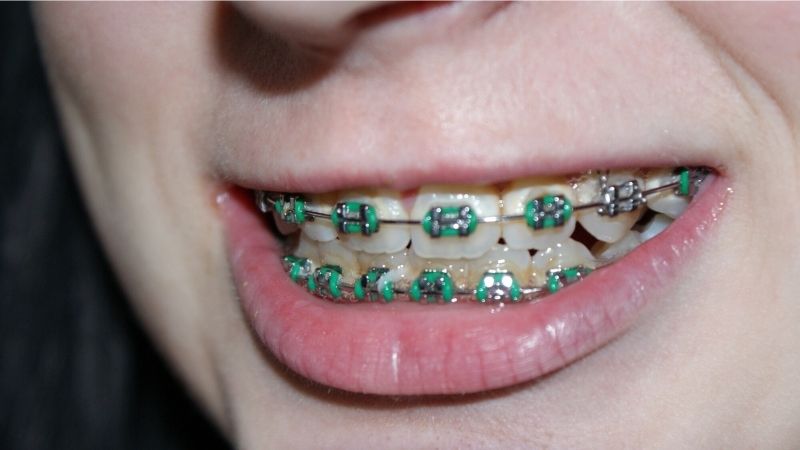 Here's How Much It Costs to Get Braces