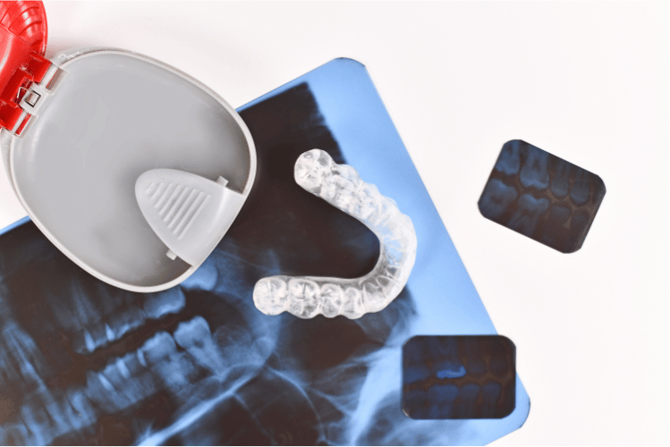 Can clear aligners fix an underbite?