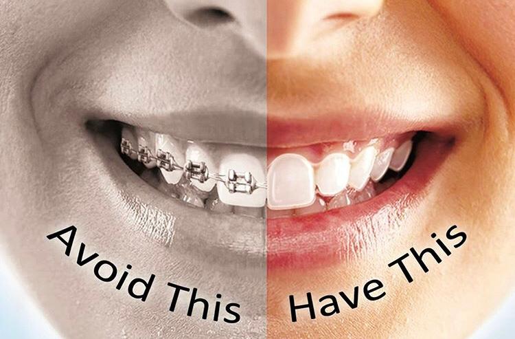 Do Adult Braces Actually Work For Straightening Your Teeth?