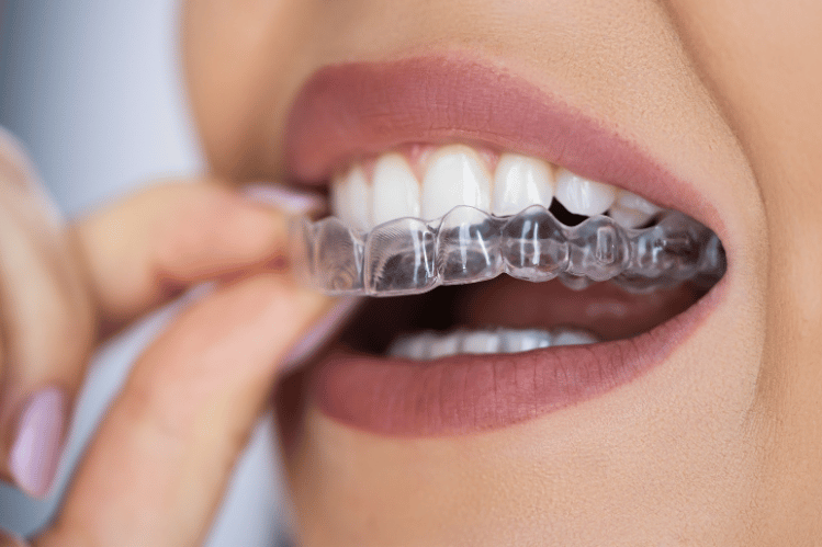 How Clear Aligners Work: Your Step-by-Step Guide to a Straighter Smile