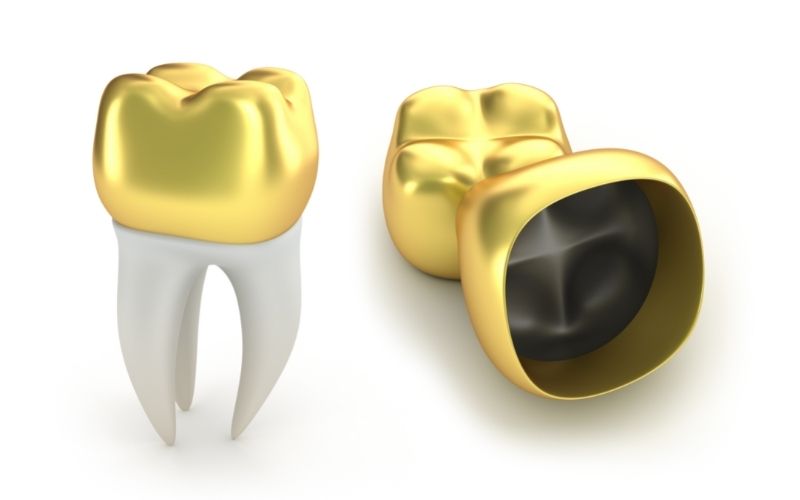 What Is a Dental Crown?