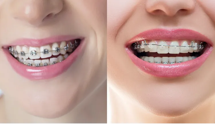 The Difference between Metal Braces and Ceramic Braces