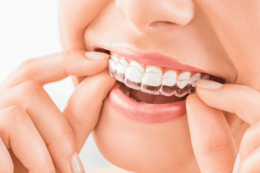 Progress Tracking with Invisible Aligners