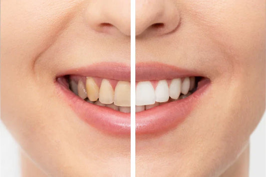 Before and after of whitened teeth
