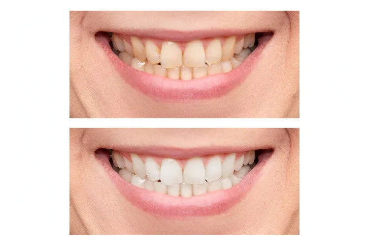 Teeth Whitening Before and After