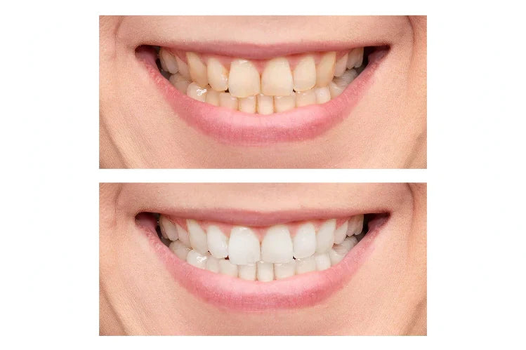Teeth Whitening Before and After