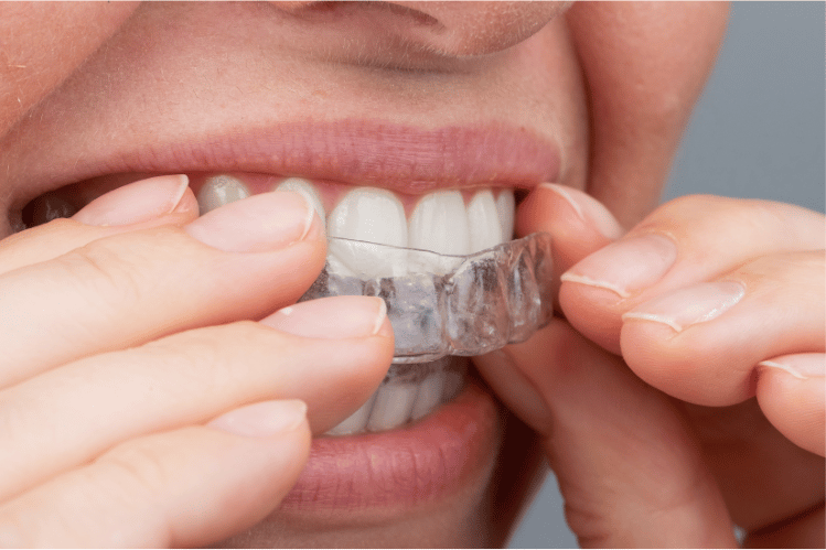 Invisalign Invisible Braces  Free Teeth Whitening Included
