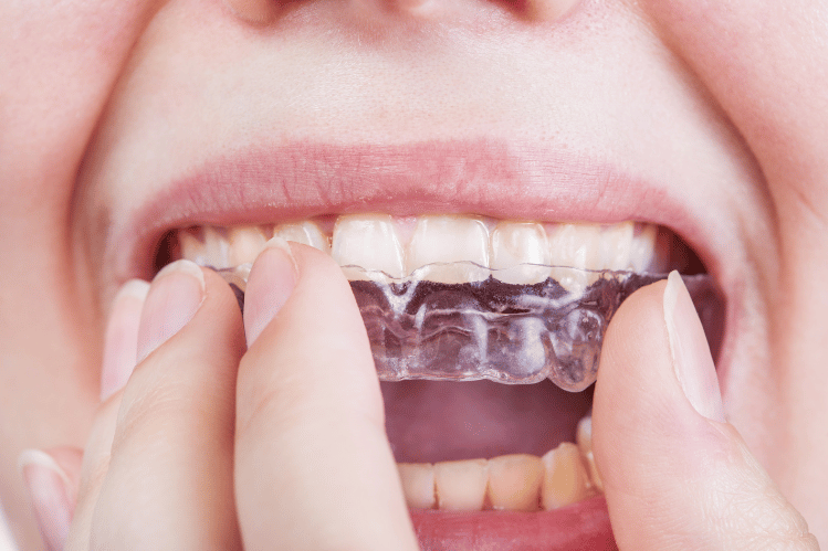 Your 2023 Invisible Braces and Clear Braces Guide, Top Pediatric Dentist  and Orthodontist