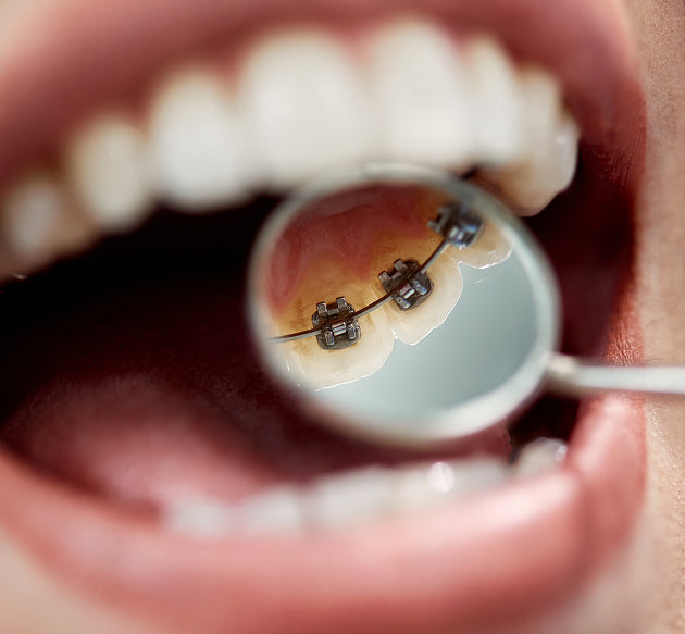 Lingual Braces