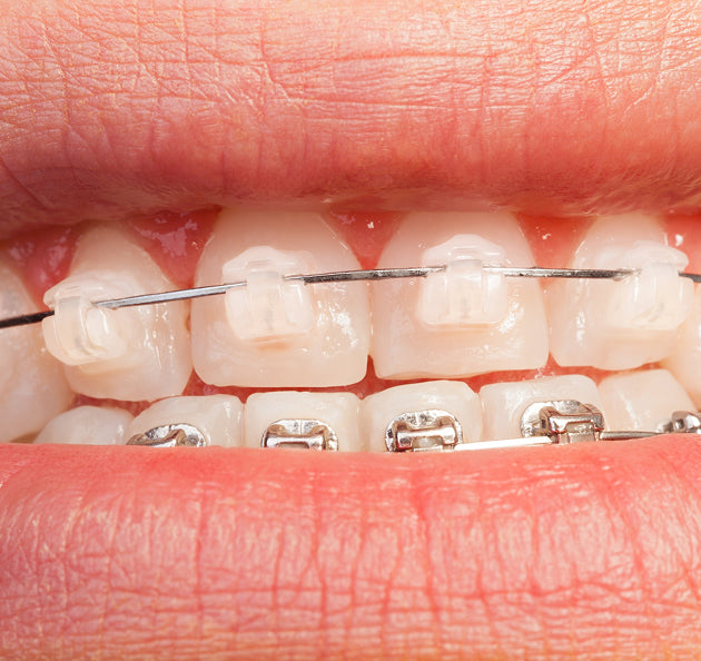 Ceramic Braces