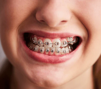Traditional Metal Braces