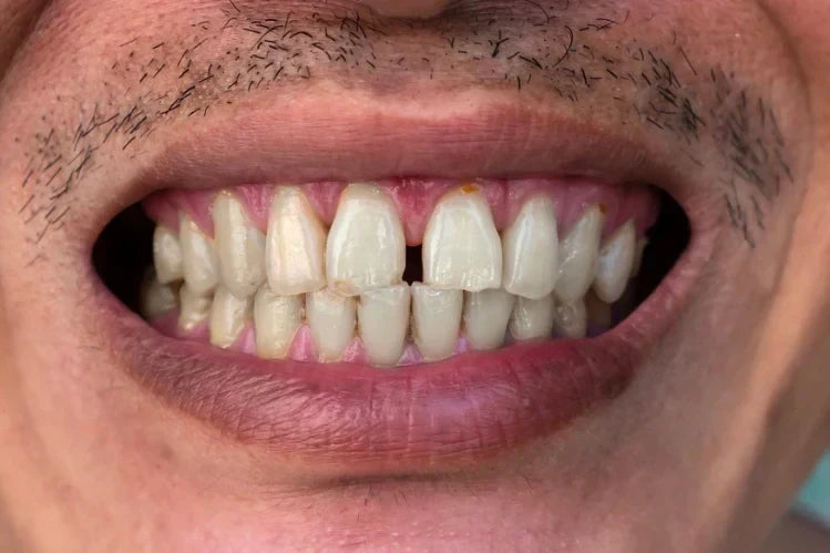 Teeth Straightening for Adults: An 18+ Analysis