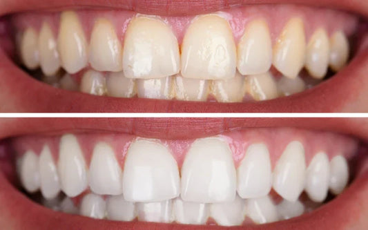 before and after teeth whitening pen