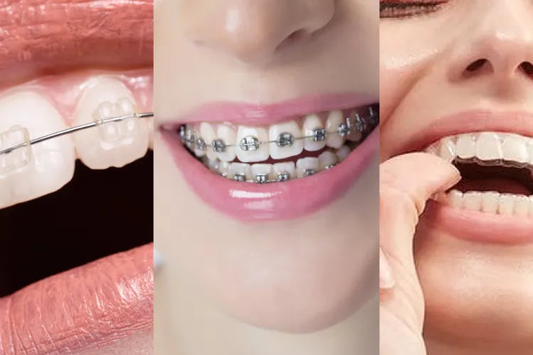 Teeth straightening