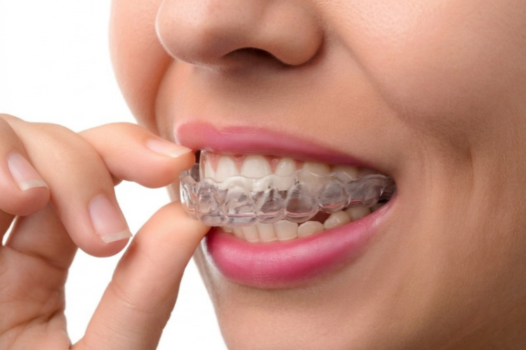 Close-up of a woman putting on a clear aligner