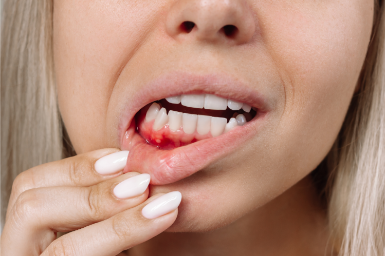 Woman pulling down her lip to show red, bleeding gums
