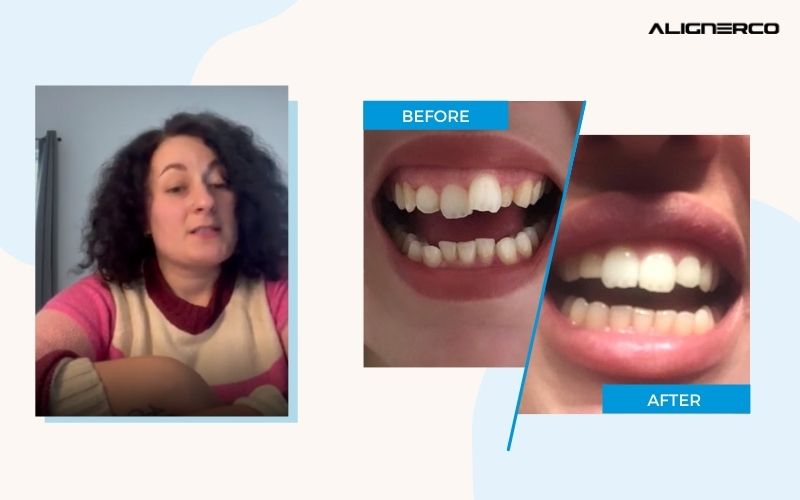 A Tale of Self-Love and ALIGNERCO Results: Ash Amendola's Teeth Straightening Journey