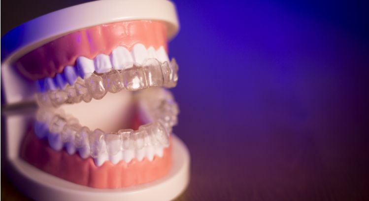 ALIGNERCO vs. Metal Braces: The Better Choice