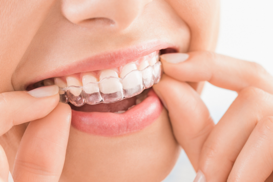 Close-up of fingers placing a clear aligner on upper teeth