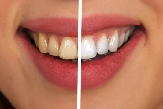 A girl shows her teeth before and after teeth whitening 