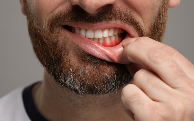  Gingivitis 