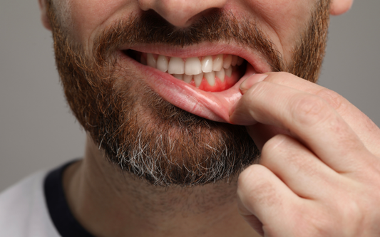 Gingivitis