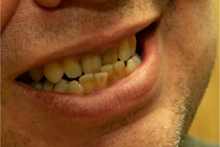  A man with misaligned bottom teeth