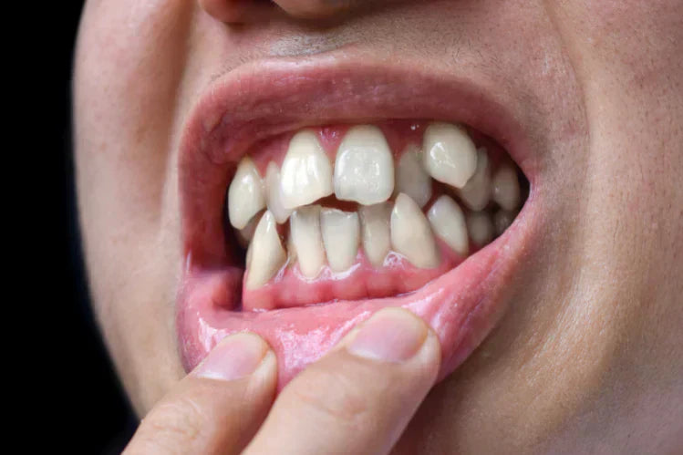 A person showing crooked teeth. 