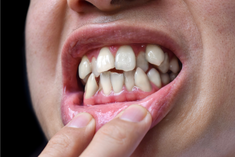 A person showing his crooked teeth