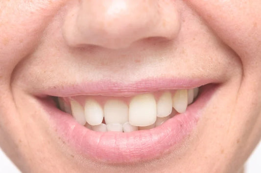 A person smiling with slanted front teeth
