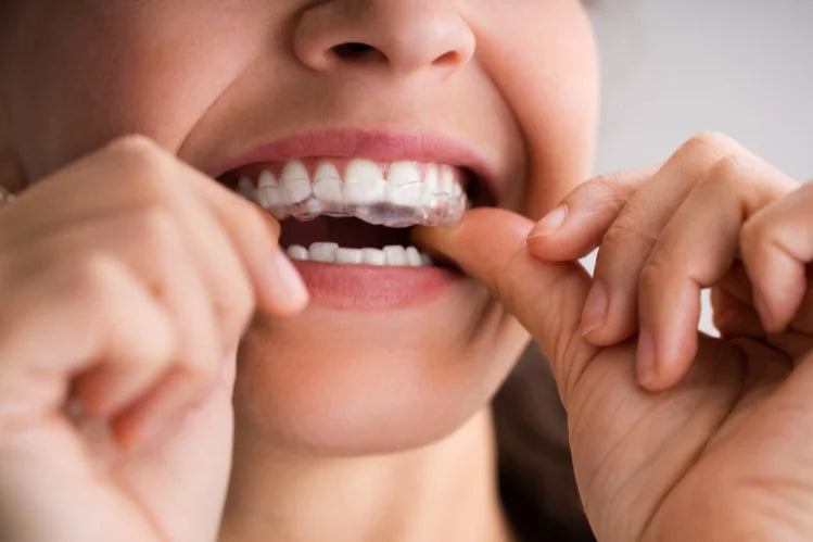 A woman applying clear aligners. 