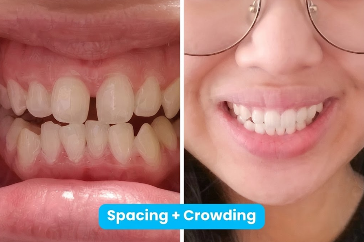 Before and after smile showing spacing and crowding corrected by aligners