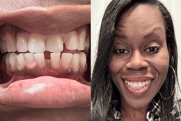 Aiesha Marshall’s ALIGNERCO Journey: A Smile Worth Taking a Chance On