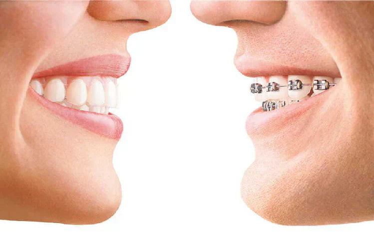 Aligners vs. Braces