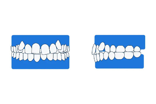 An illustration of crooked teeth