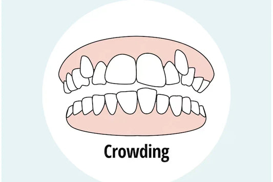 An illustration of crowded teeth