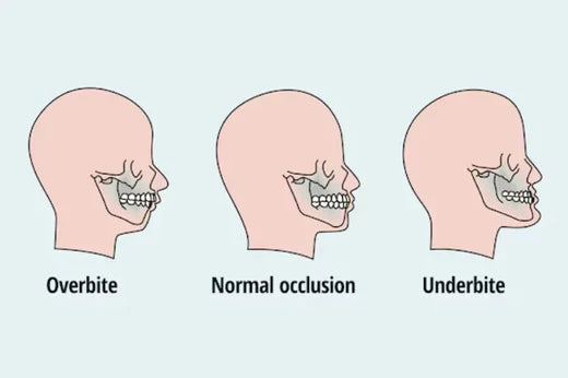 image of an overbite, a normal bite, and an underbite