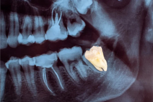 An X-ray showing posterior teeth