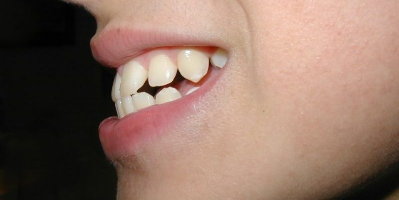 Are Braces Necessary for Fixing an Overbite?