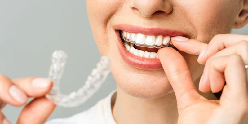 At-HomeTeeth Straightening 