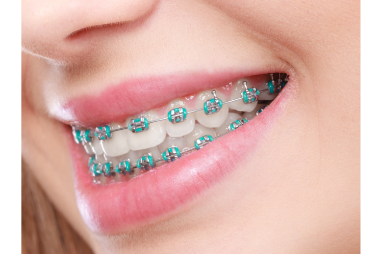 Close-up image of a woman with blue braces